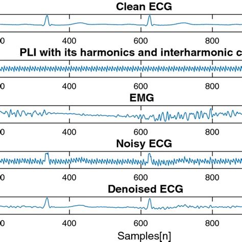 ECG Denoising For The PLI And EMG Noises From Top To Bottom A Clean