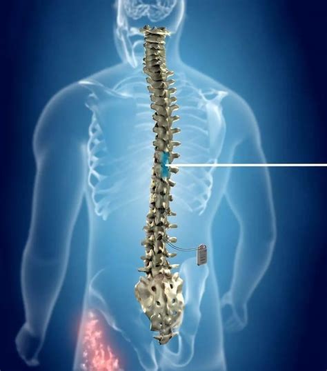 High-Frequency Spinal Cord Stimulation for Newburyport, Danvers and