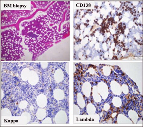 Bone marrow biopsy H E 40Â cellular core biopsy Download