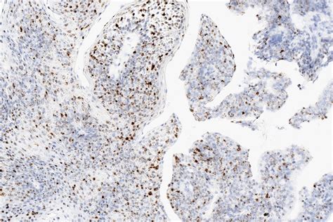 Pathology Outlines Papilloma