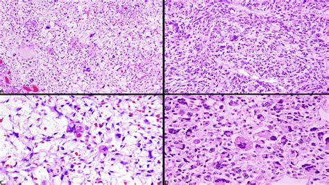 Undifferentiated Embryonal Sarcoma A D Low Power High Power And