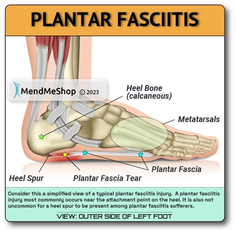 Plantar Fasciitis Information And Treatments