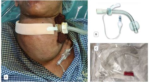 A Paramedian Tracheostomy With An Adjustable Flange Tracheostomy Tube