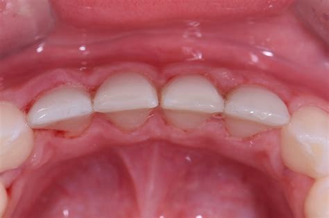 Severe Enamel Dysplasia | Non-Invasive Restorative Dentistry