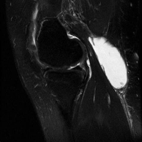 Baker Cyst Radiology Reference Article Radiopaedia Org Baker S