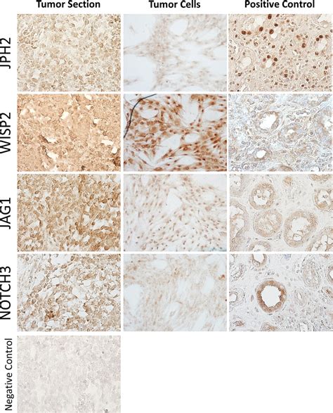 Immunohistochemical Characterization Of The Primary Undifferentiated