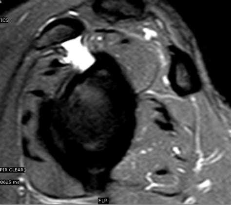 Subcoracoid Subscapularis Bursa Mri Sumer S Radiology Blog