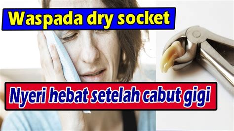 DRY SOCKET NYERI HEBAT SETELAH CABUT GIGI YANG HARUS DIWASPADAI