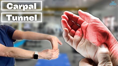 The Best Treatments For Carpal Tunnel Syndrome Youtube