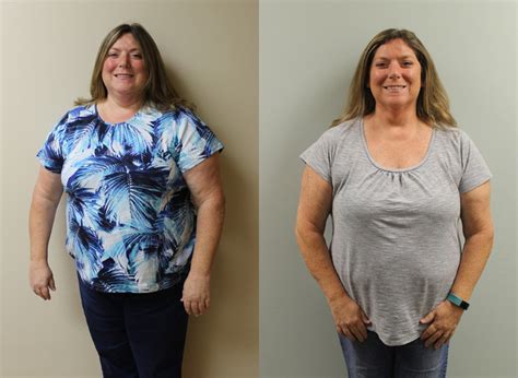 Bariatric Weight Loss Surgery Before And After In St Louis