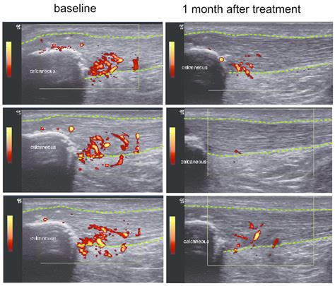 Effect Of Dobesilate Injection In Insertional Achilles Tendinopathy