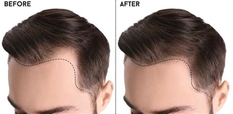 Top 10 Clinics For Hair Transplant In Turkey