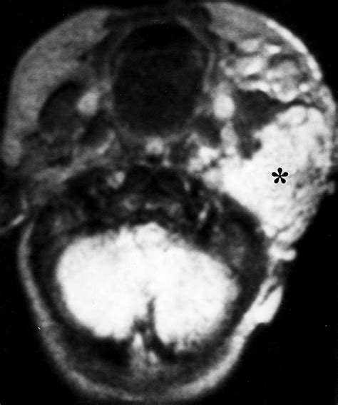 Superficial Soft Tissue Masses Analysis Diagnosis And Differential