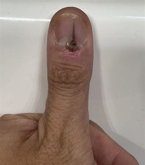 Melanoma Under Nail Bed Photos My Bios