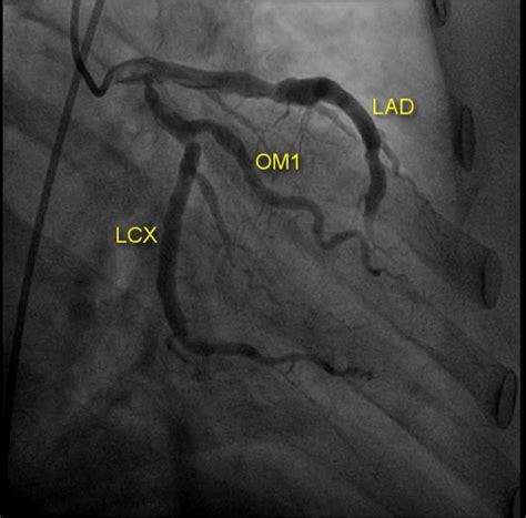 Coronary Artery Ectasia A Rare Cause Of Acute Coronary Syndrome Bmj