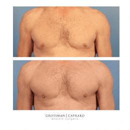 Gallery Of Pectoral Implants Grossman Capraro Plastic Surgery