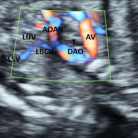 (PDF) Diagnosis of retrotracheal left brachiocephalic vein with prenatal ultrasound: a case report