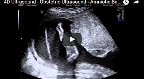 Amniotic Band Type I Obstetric Ultrasound 4d Ultrasound Ultrasound