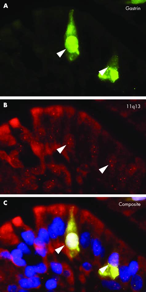 Loss Of Heterozygosity Loh Analysis Of Gastrin Cell Hyperplasia Download Scientific Diagram