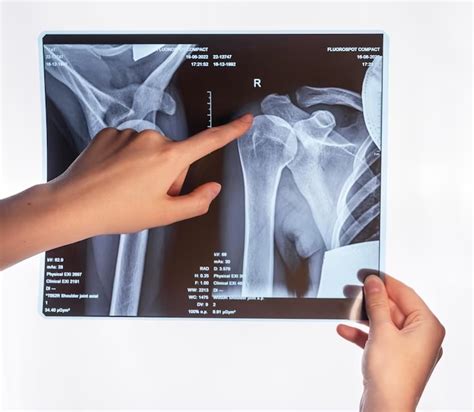 Luxa O Acromioclavicular Diagn Stico E Tratamento Portal Da Ortopedia