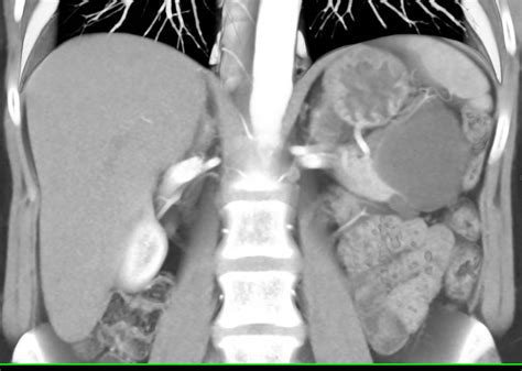 Lymphoepithelial Cyst Of The Tail Of The Pancreas Pancreas Case