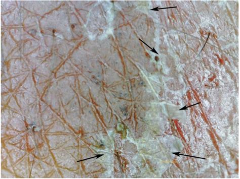 Tropicalmed Free Full Text In Situ Diagnosis Of Scabies Using A Handheld Digital Microscope