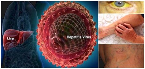 Hepatitis C Signs And Symptoms And Results In Mayo Clinic More In Cancer A Z