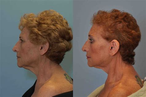 Facelift Gallery Dr Paul Vanek Mentor Plastic Surgery