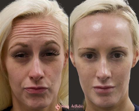 Botox Before And After Forehead