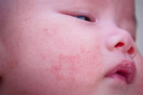 Baby Acne: Causes, Treatments and Tips