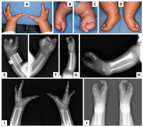 Ectrodactyly X Rays