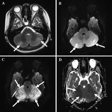 Clinical analysis of late-onset methylmalonic acidaemia and