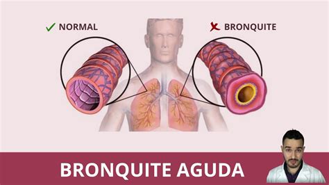 Tudo Sobre Bronquite Aguda Youtube