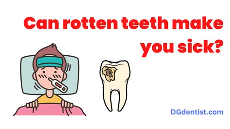 Rotten Teeth: Causes, Symptoms & Treatment - DG Dentist