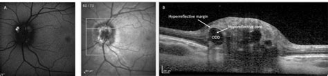 OCT imaging of optic disc drusen (ODD) in a 48-year-old male. Optic ...