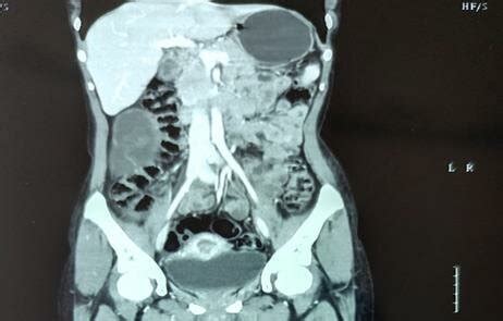 CECT abdomen and pelvis. | Download Scientific Diagram