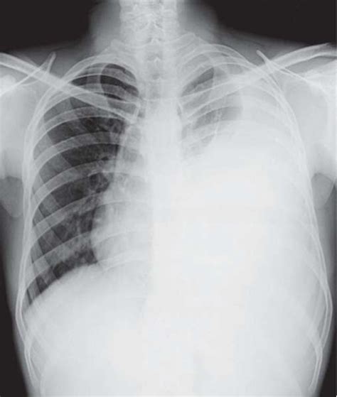 Study Medical Photos: Pleural effusion On Chest X ray