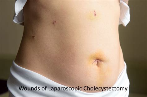 Laparoscopic Cholecystectomy