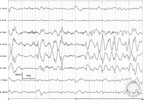 The Interictal Eeg Recording Shows Pseudoperiodic High Amplitude Slow