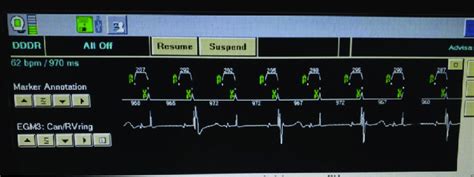 Pacemaker Interrogation During Emergency Department Visit Showing 21 Download Scientific