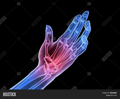 X-ray Hand - Arthritis Image & Photo (Free Trial) | Bigstock