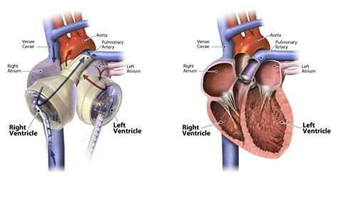 A Complete Guide To Artificial Heart Transplant Procedure - India4world