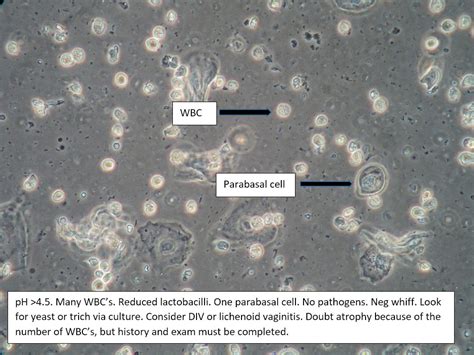 Vaginal Microscopy Summary Table B Issvd