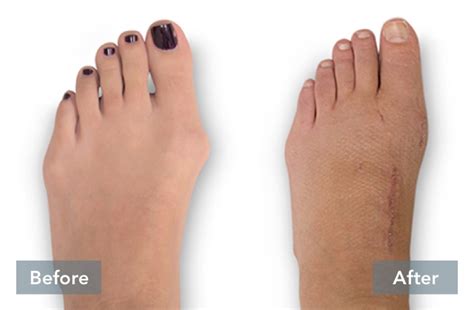 Lapiplasty Bunion Correction In Redding California