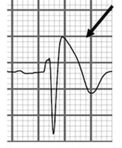 Brugada Syndrome: An ECG Pattern You Need to Know