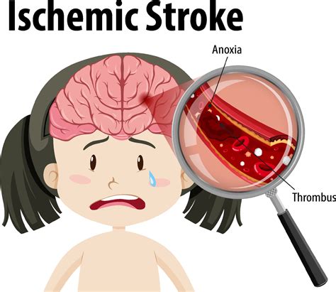 Human with Ischemic stroke 8132420 Vector Art at Vecteezy