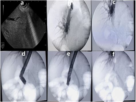 A Eus Guided Puncture Of Intrahepatic Duct B Contrast Injection