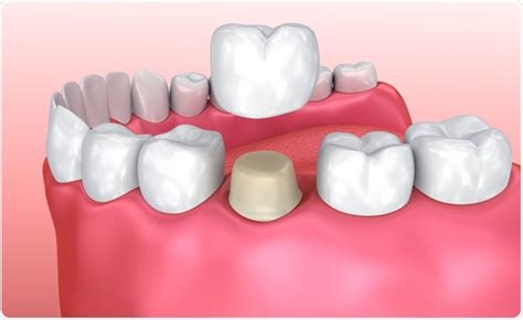 Serious Dental Crown Problems Know Them Now