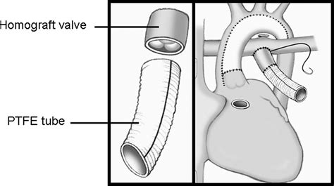 Homograft Valved Right Ventricle To Pulmonary Artery Conduit As A