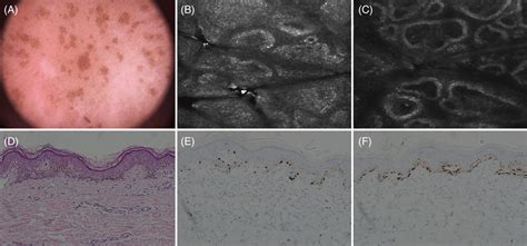 A Dermoscopy Showed Different Sizes Dark‐brown Structureless Download Scientific Diagram